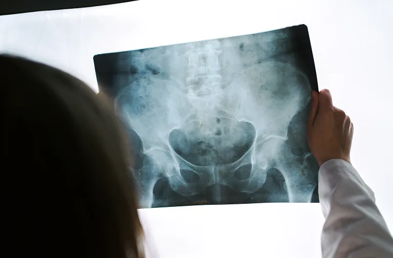 AVN Avascular Necrosis | Ayusya Ayurveda