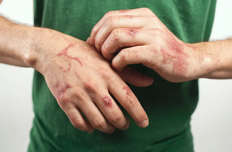 Autoimmune Disease | Ayusya Ayurveda